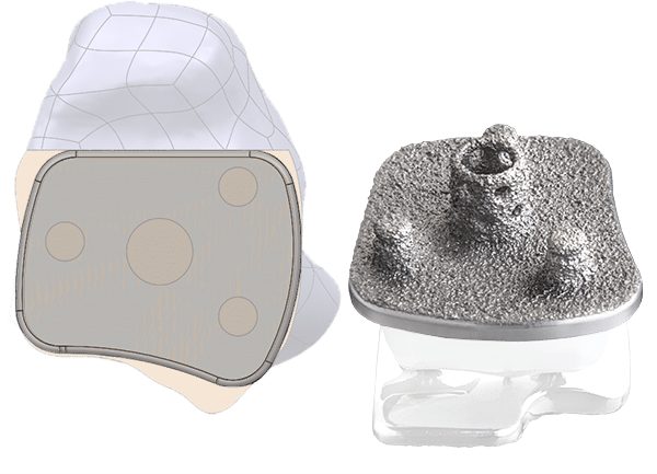 Advita Vantage Total Ankle