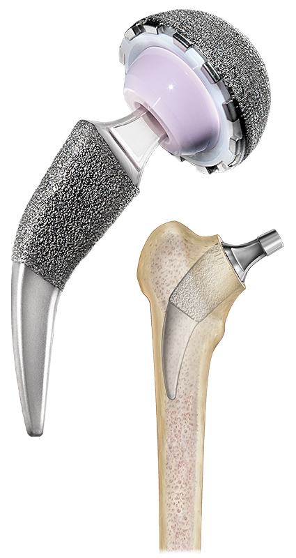 Alteon Hip Primary Femoral Neck Preserving Stem