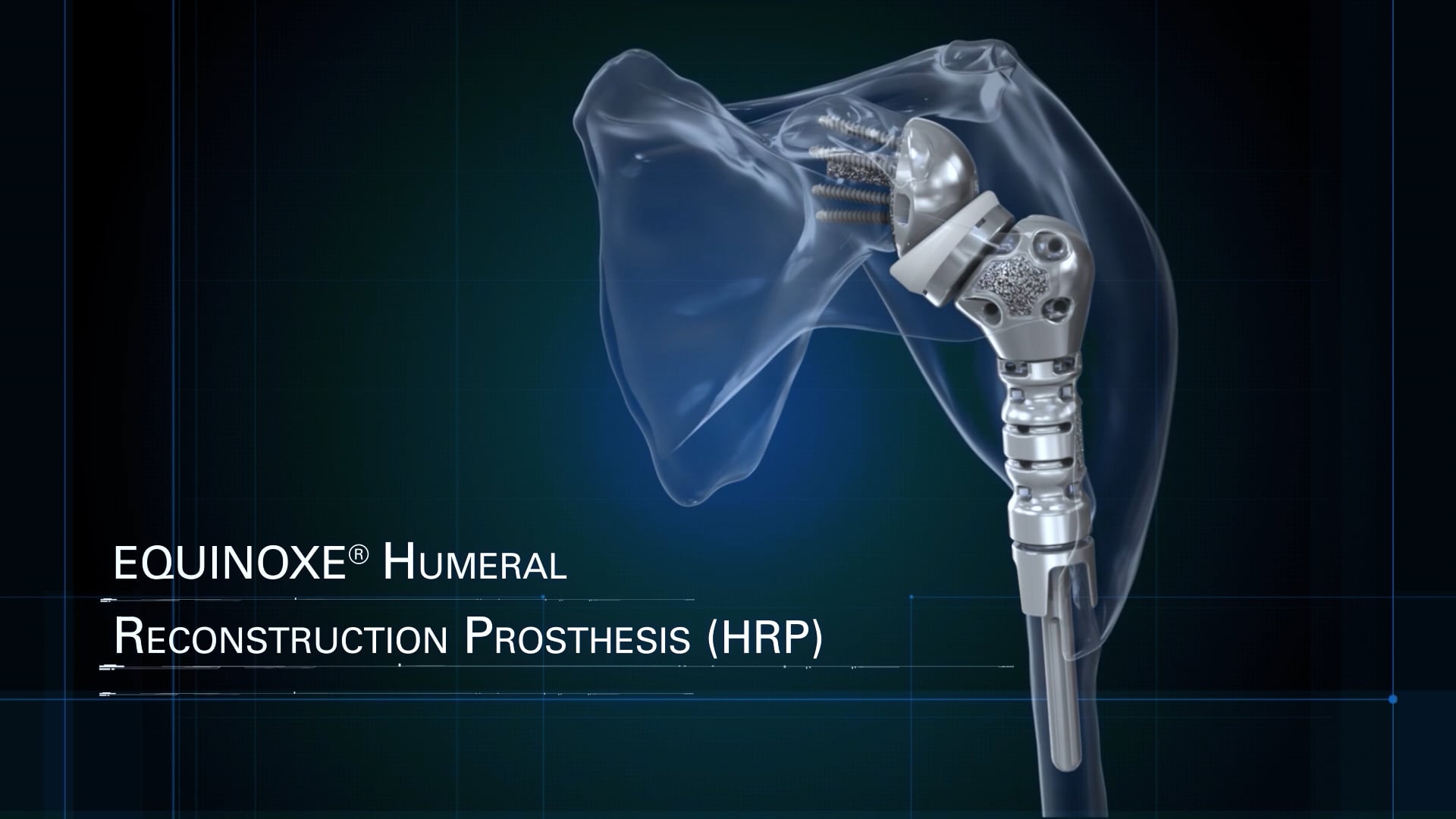 Equinoxe Shoulder Humeral Reconstruction Prosthesis Overview Animation